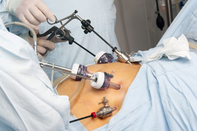 Gastric bypass surgery Novi, Michigan