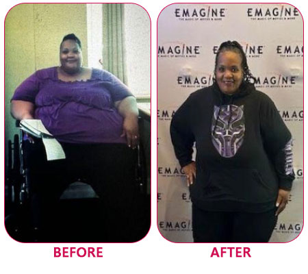 Weight loss surgery Novi, Michigan