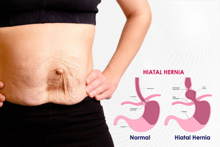 Hiatal Hernia Surgery for GERD