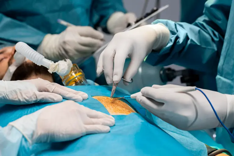 Hernia Surgery